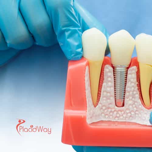 All-on-4 Dental Implants for Vancouver Patients in Tijuana, Mexico